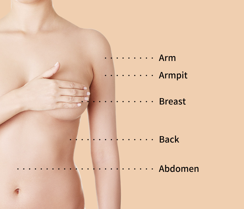 Areas for Non-invasive lifting