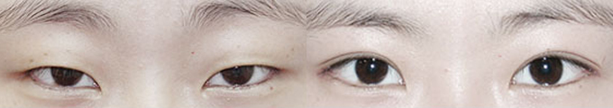 Operation method - Incision & Lateral canthoplasty