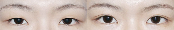 Operation method - Incision & Epicanthoplasty + Lateral canthoplasty