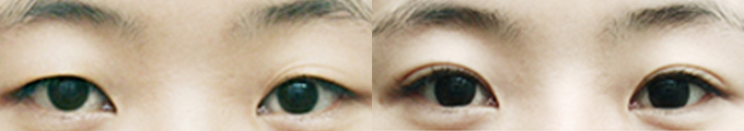 Operation method - Total Incision Ptosis Correction