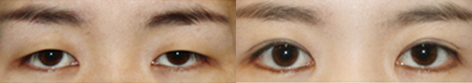 Operation method - Total Incision Ptosis Correction