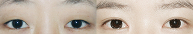 Operation method - Total Incision Ptosis Correction