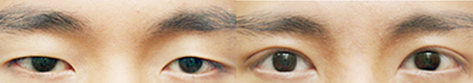 Operation method - Total Incision Ptosis Correction