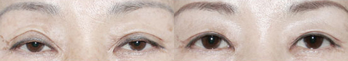 Operation method : Upper Blepharoplasty