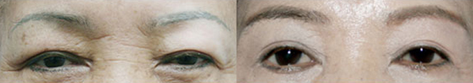 Operation method : Upper Blepharoplasty