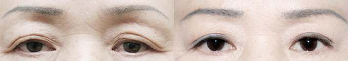 Operation method : Upper Blepharoplasty & Lower Blepharoplasty & Under Eye Fat Graft