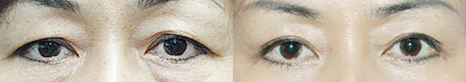 Operation method : Upper Blepharoplasty & Lower Blepharoplasty & Under Eye Fat Graft