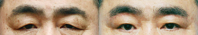 Operation method - Brow Lift & Lower Blepharoplasty & Under Eye Fat Graft