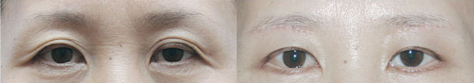 Operation method - Brow Lift