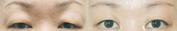 Operation method - Brow Lift