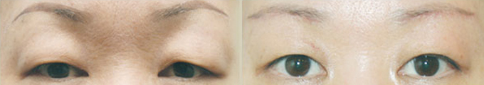 Brow Lift