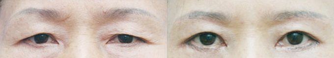 Operation method - Brow Lift