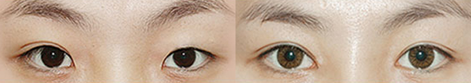 Epicanthoplasty & Non-Incisional Double Eyelid