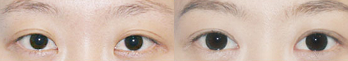 Epicanthoplasty & Non-Incisional Double Eyelid