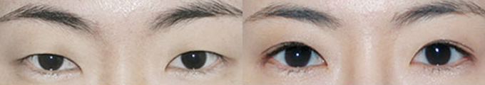 手术方法 : 开外眼角术 & 非切开式双眼皮术