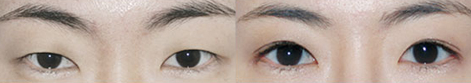 Lateral Canthoplasty & Non-Incisional Double Eyelid