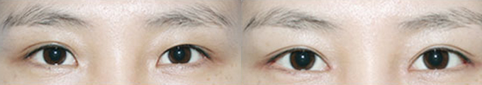 手术方法 : 开外眼角术 &开内眼角术 & 非切开式双眼皮术