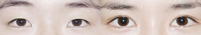 Lateral Canthoplasty & Epicanthoplasty & Non-Incisional Double Eyelid