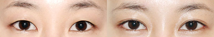 Lateral Canthoplasty & Non-Incisional Double Eyelid