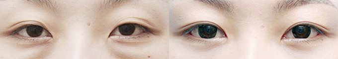 Under Eye Bag Correction & Total Incisional Double Eyelid