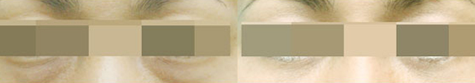 Under Eye Bag Correction