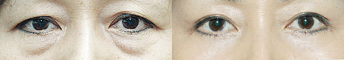 Upper Blepharoplasty & Lower Blepharoplasty & Under Eye Fat Graft