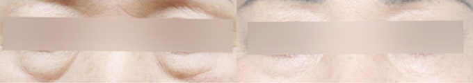 Lower Blepharoplasty