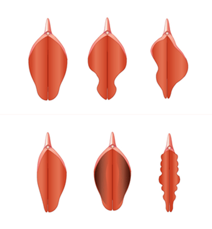 Various types of Labia Minora