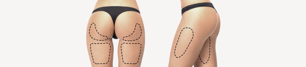 Thigh Liposuction