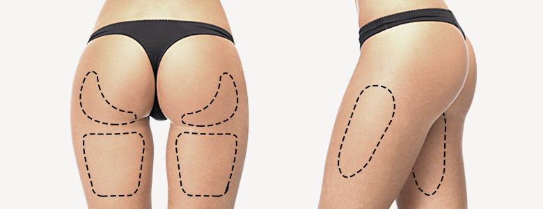 Thigh Liposuction