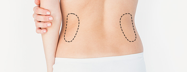 Waist Liposuction