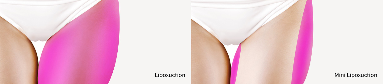 Mini Liposuction