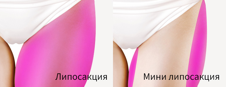 Мини Липосакция