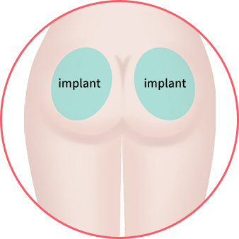 Implant Insertion