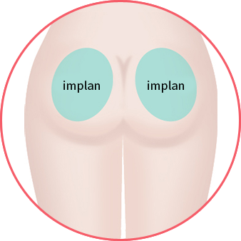 Pemasukan implan