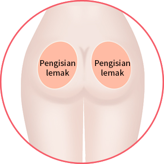 Pengisian lemak