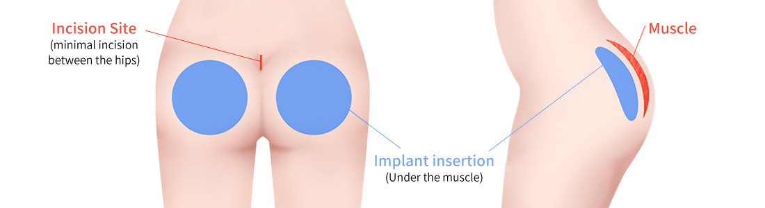 Implant insertion