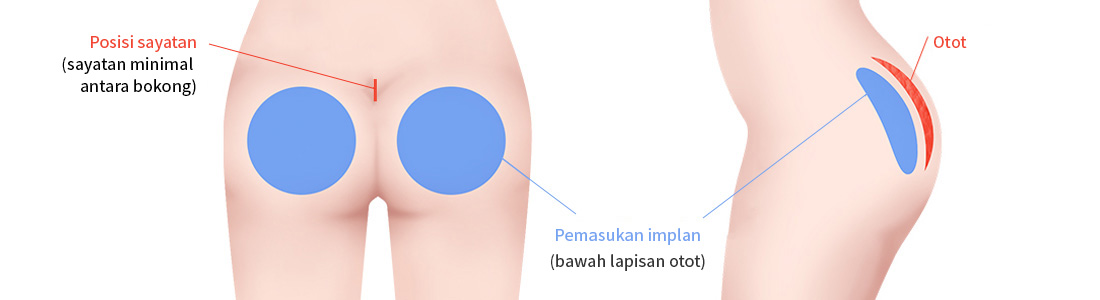 Pemasukan implan