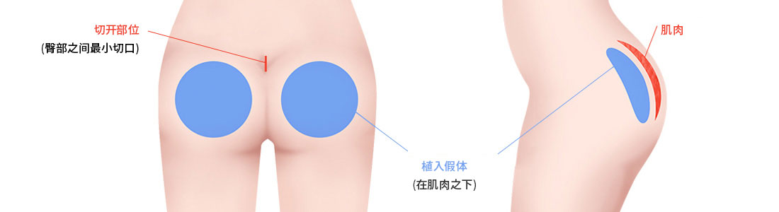 プロテーゼ挿入法