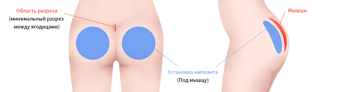 Имплантат