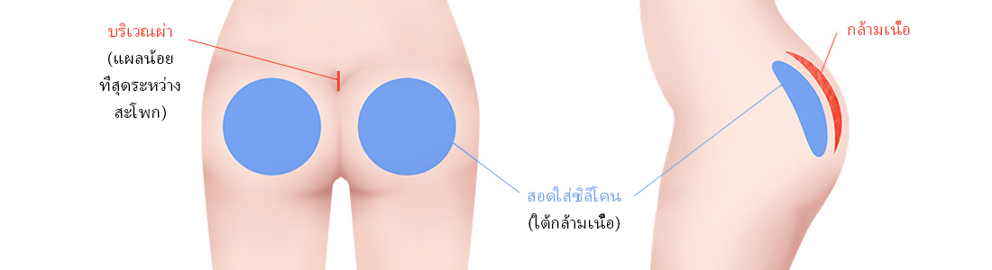 วัสดุเสริม