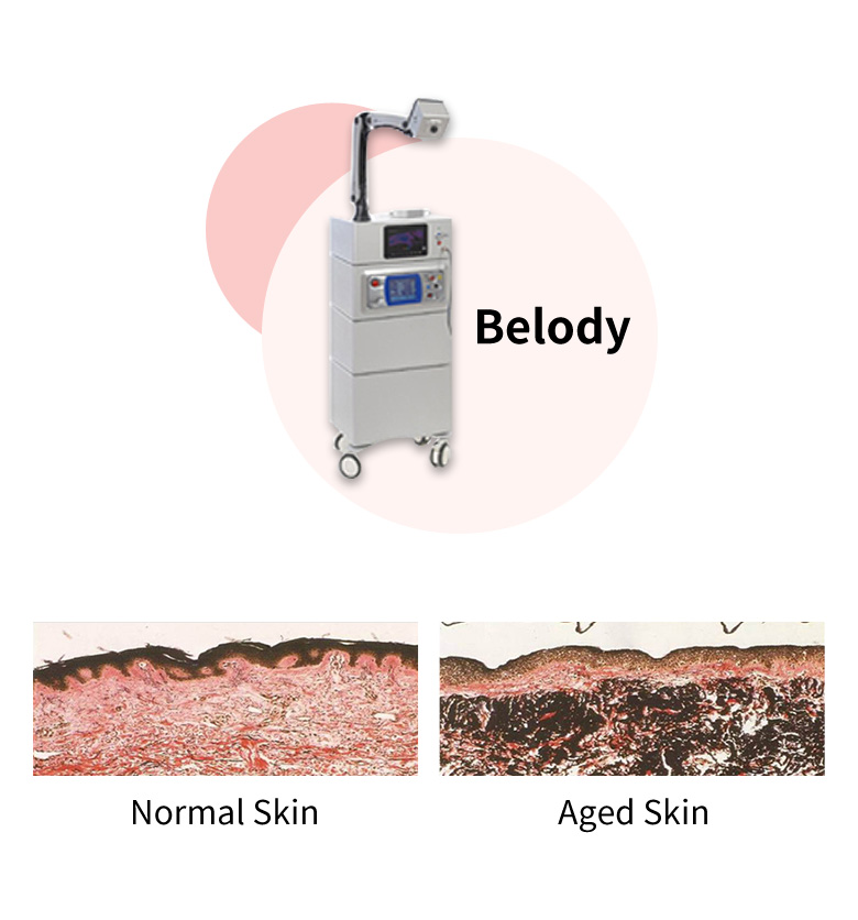 细胞激光（Belody）