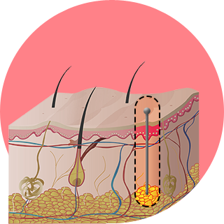 Suction the fat through cannula