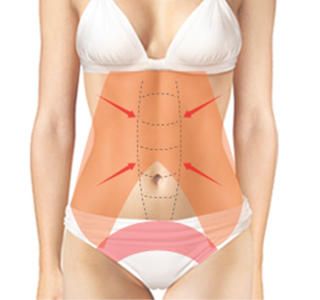 Quá trình phẫu thuật chỉnh hình phần bụng 2