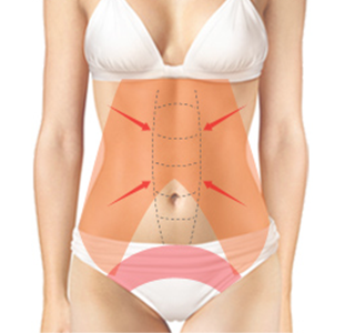 Proses operasi Tummy Tuck Jenis 2