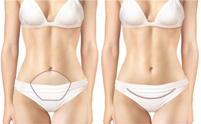 Tummy Tuck Standar