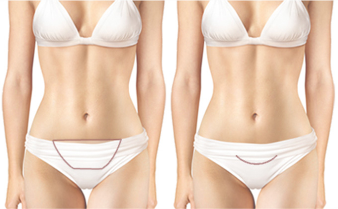 Tummy Tuck mini