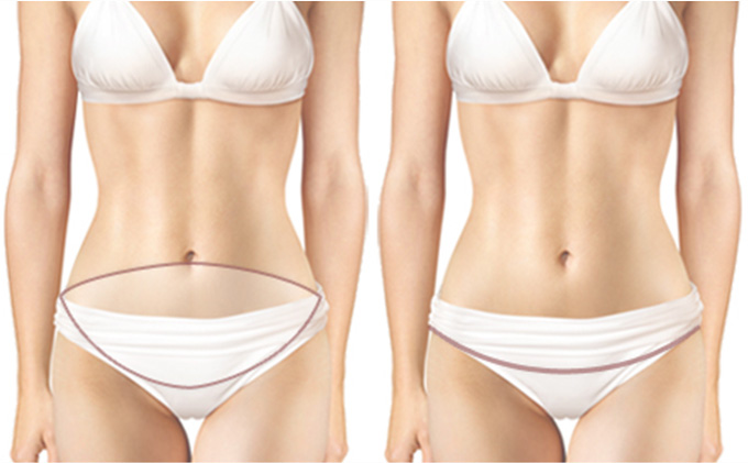 Tummy Tuck Lebar