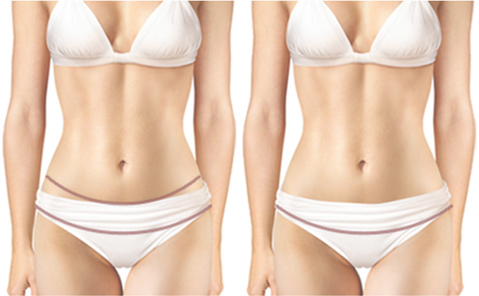 Tummy Tuck Lingkar