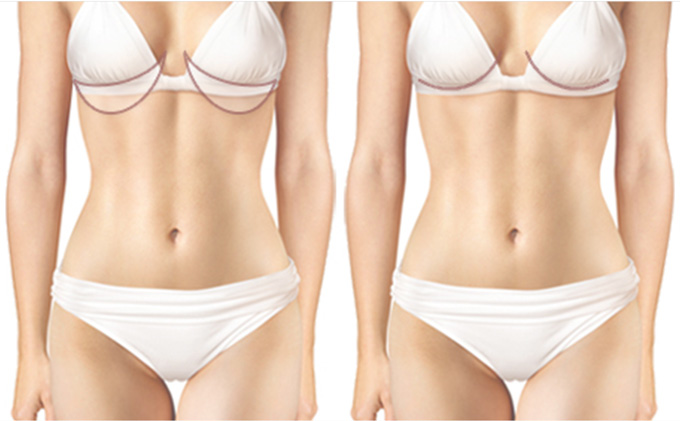 Reverse Tummy Tuck